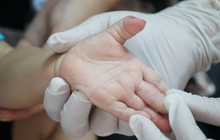 Một bệnh nhi ở Đắk Lắk tử vong vì tay chân miệng