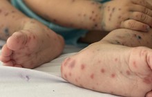 Nhiều trẻ mắc tay chân miệng trở nặng: Chuyên gia dự đoán số ca sẽ tăng cao