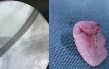 Đau bụng từng cơn, vàng da, vàng mắt do "sinh vật lạ" chui vào ống mật