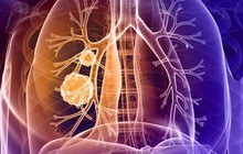 2 vị trí đau bất thường cảnh báo ung thư phổi nhưng dễ bị bỏ qua