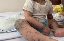 Trẻ 17 tháng tuổi mắc tay chân miệng phải lọc máu liên tục