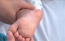 TP Hồ Chí Minh: Bệnh tay chân miệng tăng 133% trong một tuần