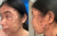 Ca bệnh hiếm gặp: Loạn sản thượng bì dạng hạt cơm tiến triển thành đa ung thư da