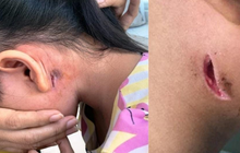 Nhiều người nhiễm vi khuẩn "ăn thịt người", Bộ Y tế ra khuyến cáo
