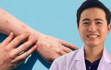 Bác sĩ: Những lý do đậu mùa khỉ không có khả năng trở thành đại dịch như Covid-19