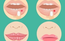 4 dấu hiệu bệnh nghiêm trọng có thể xuất hiện ở môi: Nếu thấy cần đi khám ngay