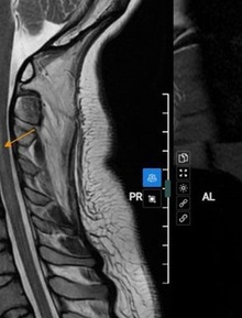 Nữ sinh 20 tuổi đột ngột bị yếu liệt tay sau khi ngủ dậy vì thói quen nhiều bạn trẻ mắc phải