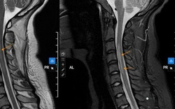 Nữ sinh 20 tuổi đột ngột bị yếu liệt tay sau khi ngủ dậy vì thói quen nhiều bạn trẻ mắc phải