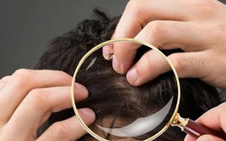 Không phải cứ có tóc bạc là lão hóa: Có 2 loại tóc trắng này trên đầu thì bạn cần đi khám sớm xem có mắc bệnh nào không
