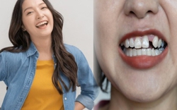 Trồng răng Implant: Đầu tư một lần, hiệu quả trọn đời, nâng cao chất lượng cuộc sống