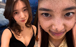 Hình ảnh gây sốc của Suzy trước khi phẫu thuật
