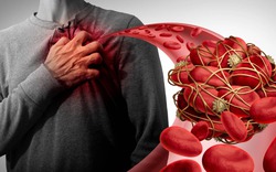 Hàng trăm cục máu đông bít tắc động mạch: "Thủ phạm" là 1 thói quen thường gặp ở người Việt