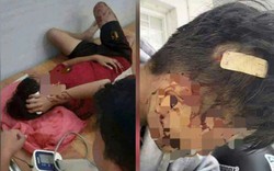 Mâu thuẫn cá nhân, học sinh lớp 8 bị bạn dùng gậy đánh nhập viện