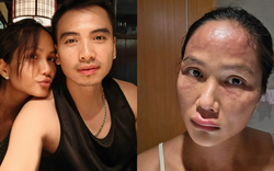 Hoa hậu H'Hen Niê sau khi bị biến dạng mặt