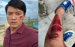 Quách Ngọc Tuyên bị tai nạn