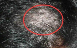 Nữ sinh 14 tuổi rụng sạch tóc vì thói quen này của nhiều người
