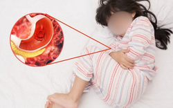 Bé trai 12 tuổi xuất huyết tiêu hóa, 3 tháng nhập viện 2 lần vì loại vi khuẩn 70% dân số Việt Nam nhiễm