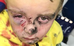 Bé trai 5 tuổi bị chó dữ tấn công khi đang đi dạo ở công viên