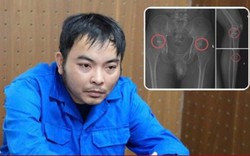 Cựu nhân viên y tế đục vỡ xương trục lợi bảo hiểm: Thủ đoạn tàn nhẫn, bất nhân