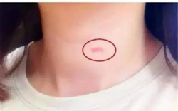 Thấy con gái 14 tuổi có "dấu vết lạ" trên cổ, hành động của người mẹ sau đó khiến dân mạng thán phục