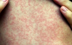 Dịch sởi bùng phát tại một xã