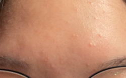 Con gái mọc mụn trứng cá, mẹ xin nghỉ phép đưa con đi cấp cứu