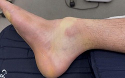 Đánh pickleball suốt 4 tiếng, nam thanh niên 28 tuổi gãy xương chân