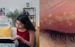 Cô gái 27 tuổi nhiễm virus Herpes sau khi mở gói hàng mua qua mạng