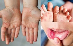 Nguy cơ dịch chồng dịch ở TP.HCM, ghi nhận hơn 3.000 ca một tuần