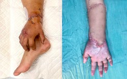 Bàn tay đứt lìa của mẹ bầu được nối lại sau thời gian 'nuôi' ở chân