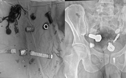 Người đàn ông liên tục đau bụng, bác sĩ sốc nặng khi phát hiện "bí mật" đáng sợ