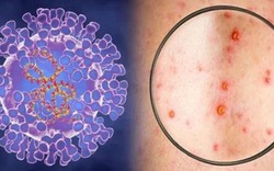 Xuất hiện ca bệnh đậu mùa khỉ chưa rõ nguồn lây ở Đồng Nai