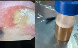 Cảnh báo hai ca viêm phổi nặng do sặc dầu