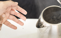 Bé 9 tháng tuổi bỏng 30% cơ thể do kéo dây nguồn ấm siêu tốc