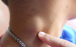 Đi khám được chẩn đoán u lành, sang nơi khác phát hiện có nhiều nhân ung thư tuyến giáp