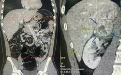 Tiểu hồng kéo dài, nam thanh niên 19 tuổi phát hiện u thượng thận 6 cm