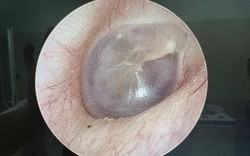 Cholesteatoma bẩm sinh: "Viên ngọc trai" nguy hiểm sau màng nhĩ