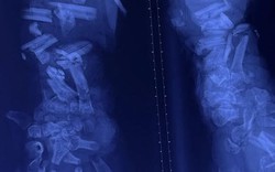 Tai nạn lao động thương tâm: Công nhân 37 tuổi bị máy nghiền vỏ dừa cán nát cánh tay