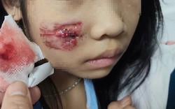 Cháu bé bị khỉ hoang tấn công khi chơi ở sân nhà