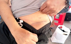 Nam thanh niên sang Campuchia làm “việc nhẹ lương cao” bị cưỡng ép cắt bỏ một quả thận: Vết sẹo dài bên mạn sườn gây ám ảnh