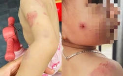 Phụ huynh bức xúc khi con gái hơn 2 tuổi chi chít vết cắn trên người sau giờ học
