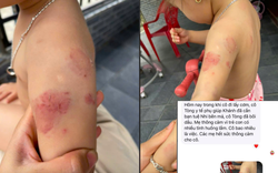 Bé hơn 2 tuổi có nhiều vết cắn, bầm tím: Giáo viên nói "quá nhiều việc", nhà trường báo "camera mất dữ liệu"