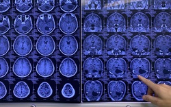 150 phút nghẹt thở với người đàn ông vào bệnh viện trong tình trạng đau đầu dữ dội