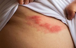 Đáng sợ cơn đau dai dẳng sau khỏi bệnh “giời leo”