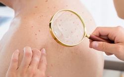 Đi khám da, bàng hoàng phát hiện nhiễm HIV: Tất cả chỉ vì 1 sai lầm của nhiều năm trước