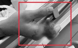 Cuộc mổ xuyên đêm cứu 4 ngón tay dập nát, gần đứt rời