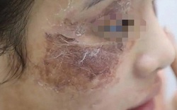 Cô gái bị tàn phá dung nhan vì bôi kem mua trên mạng