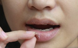 5 dấu hiệu thiếu sắt cần nhận biết sớm, xem ngay để kịp bổ sung