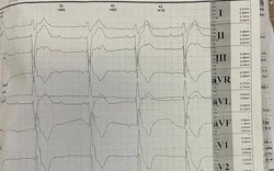 Hội chứng Kearns-Sayre - bệnh di truyền hiếm đe dọa tim mạch ở người trẻ