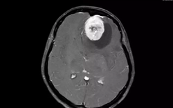 Người phụ nữ bị u màng não khổng lồ, bác sĩ chỉ ra những dấu hiệu dễ nhầm lẫn